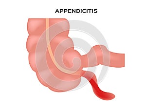 Appendicitis in white background photo
