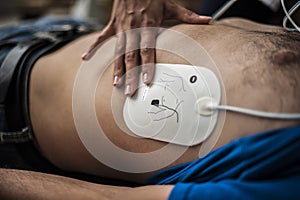 Application of defibrillation electrodes