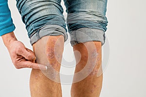 Application of therapeutic ointment for allergic rashes on the leg. Treatment of psoriasis, cosmetic and dermatological problems.