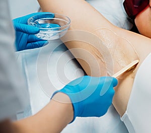 Applying a contact transparent gel before the laser hair removal procedure to the armpit area