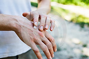 Applying an cream emollient to dry flaky skin as in the treatment of psoriasis, eczema and other dry skin conditions photo