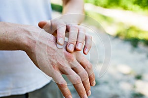 Applying an cream emollient to dry flaky skin as in the treatment of psoriasis, eczema and other dry skin conditions