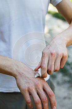 Applying an cream emollient to dry flaky skin as in the treatment of psoriasis, eczema and other dry skin conditions