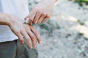 Applying an cream emollient to dry flaky skin as in the treatment of psoriasis, eczema and other dry skin conditions photo