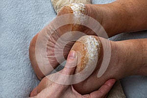 Applying cream to cracked heels. Close-up of a woman& x27;s hand applying a moisturizing nourishing cream to the heels of
