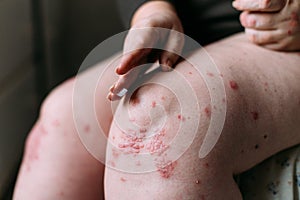 Applying an emollient to dry flaky skin as in the treatment of psoriasis, eczema and other dry skin conditions. Skin photo