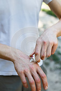 Applying an cream emollient to dry flaky skin as in the treatment of psoriasis, eczema and other dry skin conditions