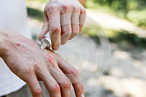 Applying an emollient to dry flaky skin as in the treatment of psoriasis, eczema and other dry skin conditions. White