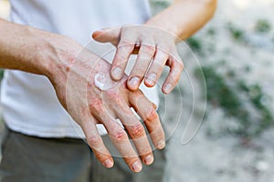 Applying an emollient to dry flaky skin as in the treatment of psoriasis, eczema and other dry skin conditions. White photo