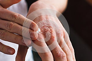 Applying an emollient to dry flaky skin as in the treatment of psoriasis, eczema and other dry skin conditions