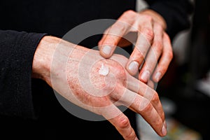 Applying an emollient to dry flaky skin as in the treatment of psoriasis, eczema and other dry skin conditions. Health