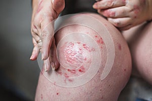 Applying an emollient to dry flaky skin as in the treatment of psoriasis, eczema and other dry skin conditions. Horizontal photo