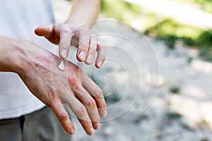Applying an emollient to dry flaky skin as in the treatment of psoriasis, eczema and other dry skin conditions. White photo