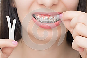 Applying orthodoentic wax on the dental braces. Brackets on the teeth after whitening. Self-ligating brackets with metal ties and