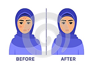 Arab Woman in Hijab with Pimples on Face. Problem Skin of a Muslim Girl. Acne treatment. Before After. Healthy Hygiene. Flat