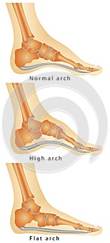 Arch of Foot photo