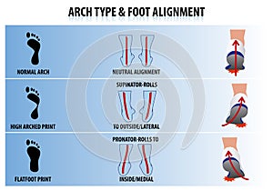 Arch Type and Foot Alignment