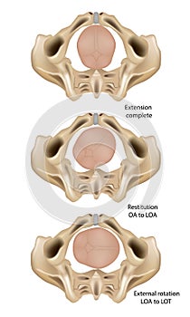 ardinal movements of Childbirth. Foetus rotation onset of labour Extension complete, Restitution OA to LOA