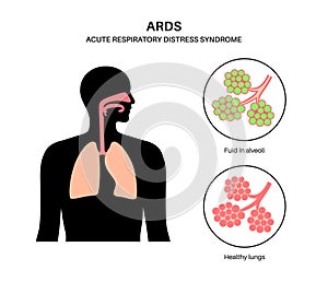 ARDS anatomical poster