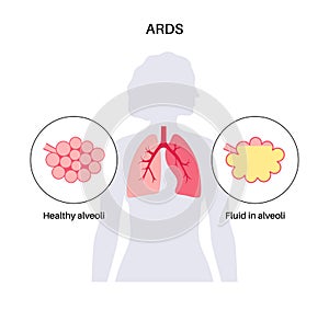 ARDS anatomical poster