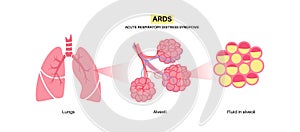 ARDS anatomical poster