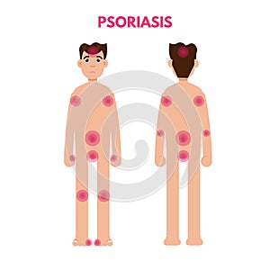 Areas of the body Psoriasis. Man nude character.