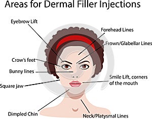 Areas for rejuvenation cosmetological injections, vector illustration for salons