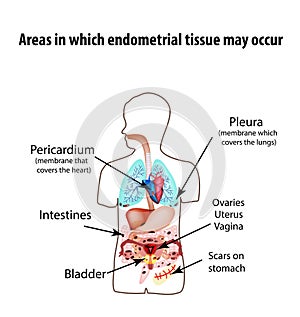 Areas in which endometrial tissue can appear. Endometriosis. Endometriosis in the body. The structure of the lungs photo