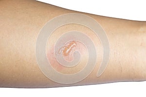 Arm with blister or burn skin