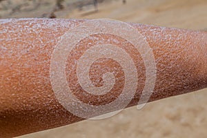 Arm covered by salt after bathing in the Dead Sea, Jord