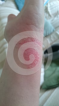 Arm eczema