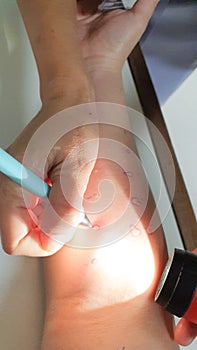 Arm examine with allergy skin prick test rash reaction aero dust mite sensitive