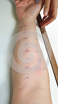 Arm examine with allergy skin prick test rash reaction aero dust mite sensitive