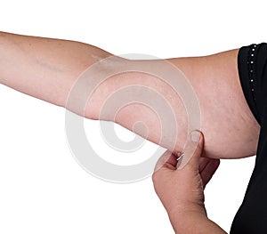 Arm fat