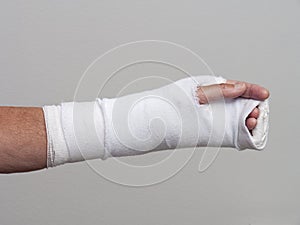 Arm and hand in cast and bandage