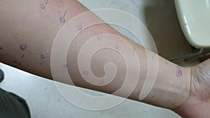 Arm showing food allergy skin prick test with rash sensitive reaction