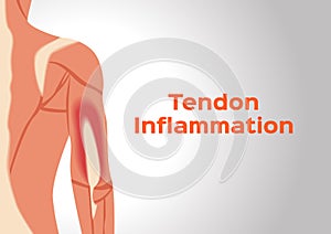 Arm tendon inflammation photo