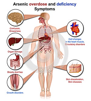 Arsenic deficiency and overdose 3d medical vector illustration isolated on white background