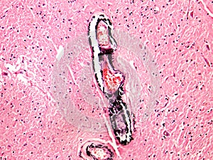 Arterial media calcification of vessels of a human brain