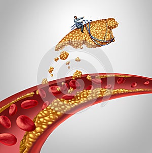 Arterial Plaque Surgery