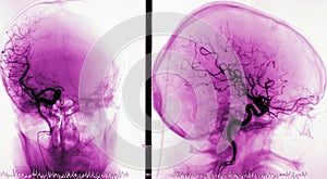 Arteriography of brain vessels