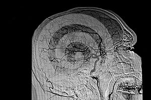 Arteriography brain image