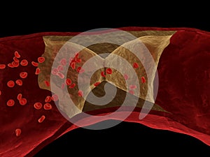 Arteriosclerosis photo