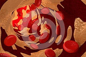 Arteriosclerosis by Cholesterol Plaque, 3D Rendering photo