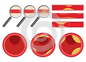 Arteriosclerosis vector design illustration isolated on white background
