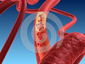 Arteriosklerosis