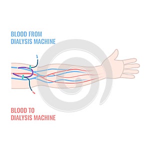 Arteriovenous dialysis shunt graft catheter in arm