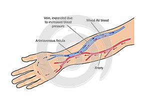 Arteriovenous fistula photo