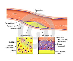 Artery atheroma plaque photo