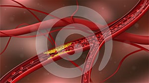 Artery blocked by cholesterol.